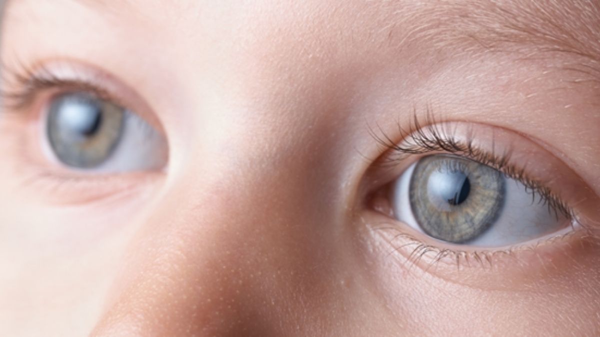 Cataract in Children