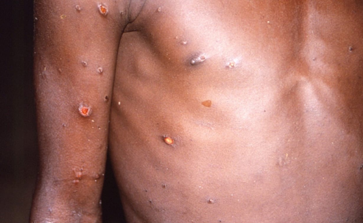 Mexico reports first imported case of monkeypox