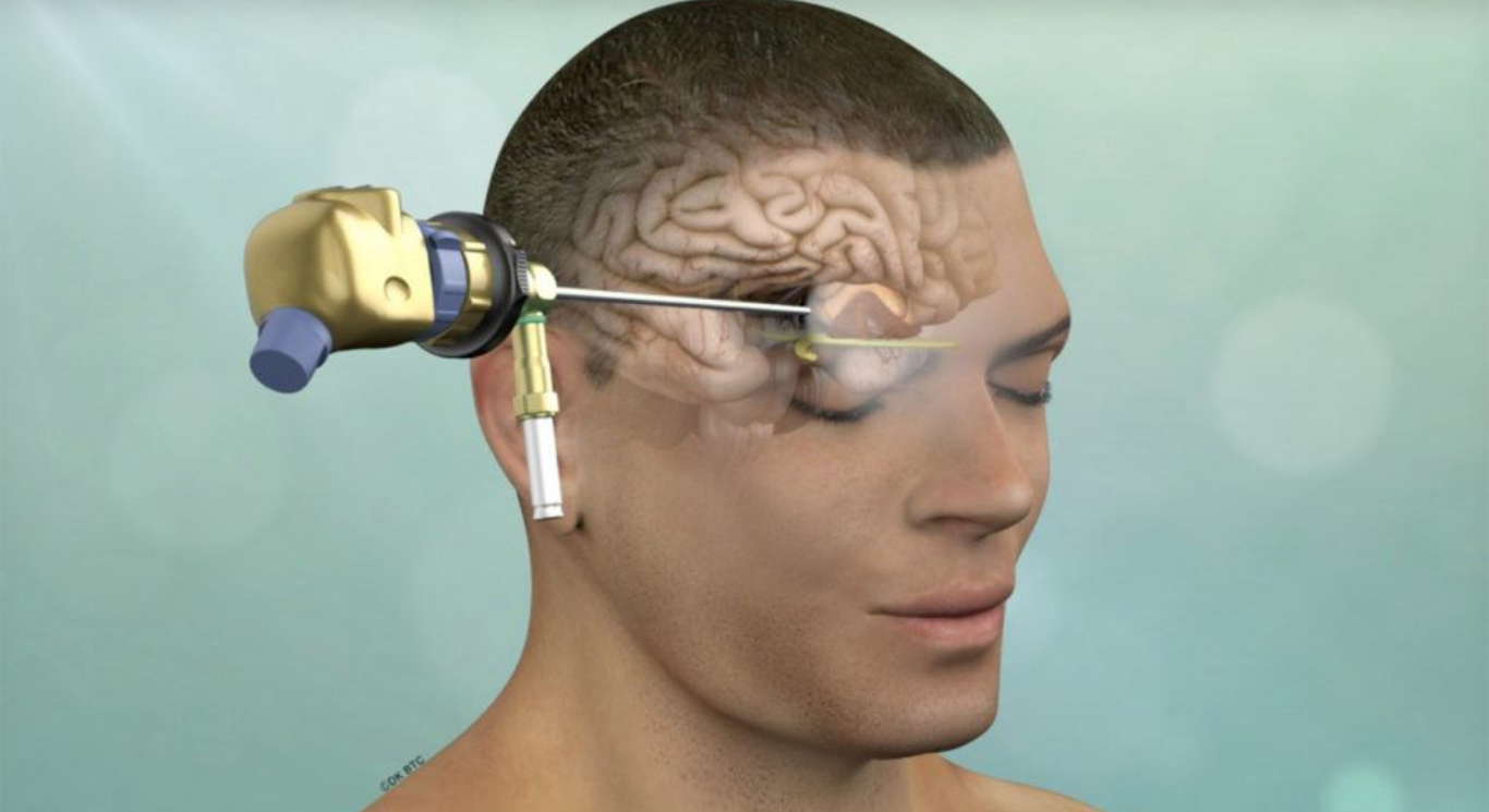 Landmark Surgery: Doctors Remove Brain Tumor Using Novel Eyebrow Keyhole Technique