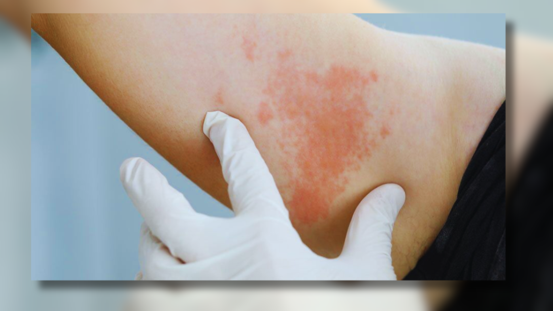 Shingles Unveiled: Understanding The Viral Infection And Its Symptoms
