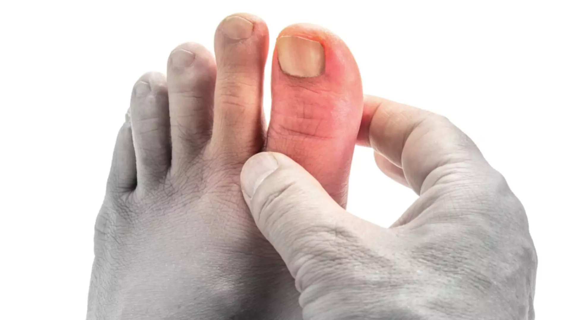 Forget Diet: Study Finds DNA Is the True Cause of Gout