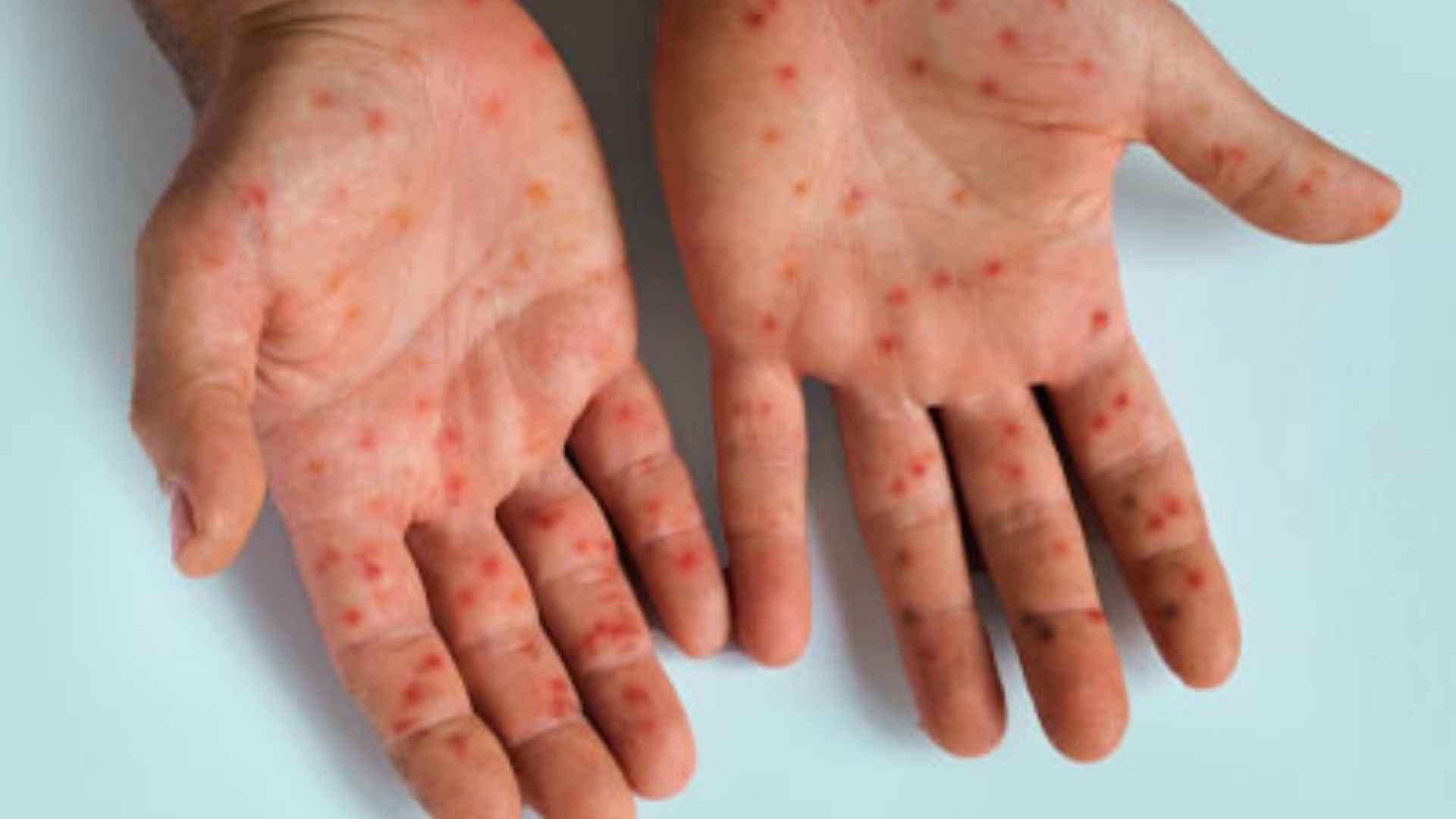 Is Mpox A Sexually Transmitted Disease? Indian Experts Argue Stigma Attached