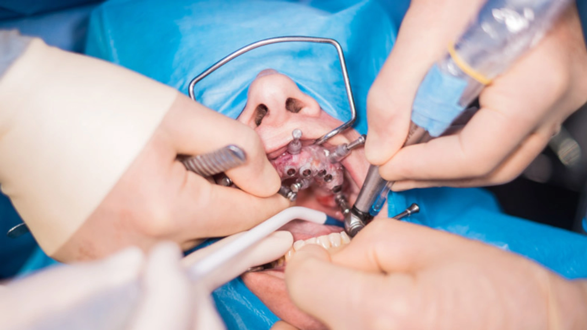 More Than Half Of Oral Cancer Patients In India Do Not Have Tobacco Or Alcohol History, Reports