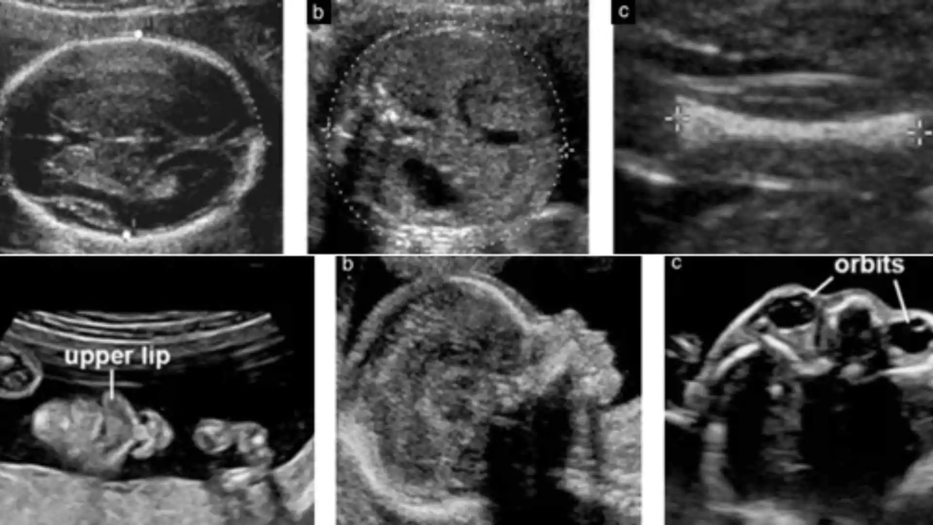 What Are Foetal Abnormalities And What Are Its Causes? All You Need To Know