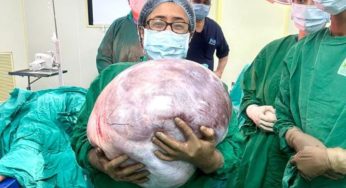 Doctors Successfully Remove 18-kg Ovarian Tumour From A 68-Year-Old woman At Pune’s Jehangir Hospital