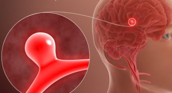 Brain Aneurysm: The Silent Threat You Shouldn’t Ignore, Know The Symptoms
