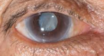 An Eye Doctor Writes: How To Prevent Early Cataract, And What Today’s Eye Surgeries Look Like