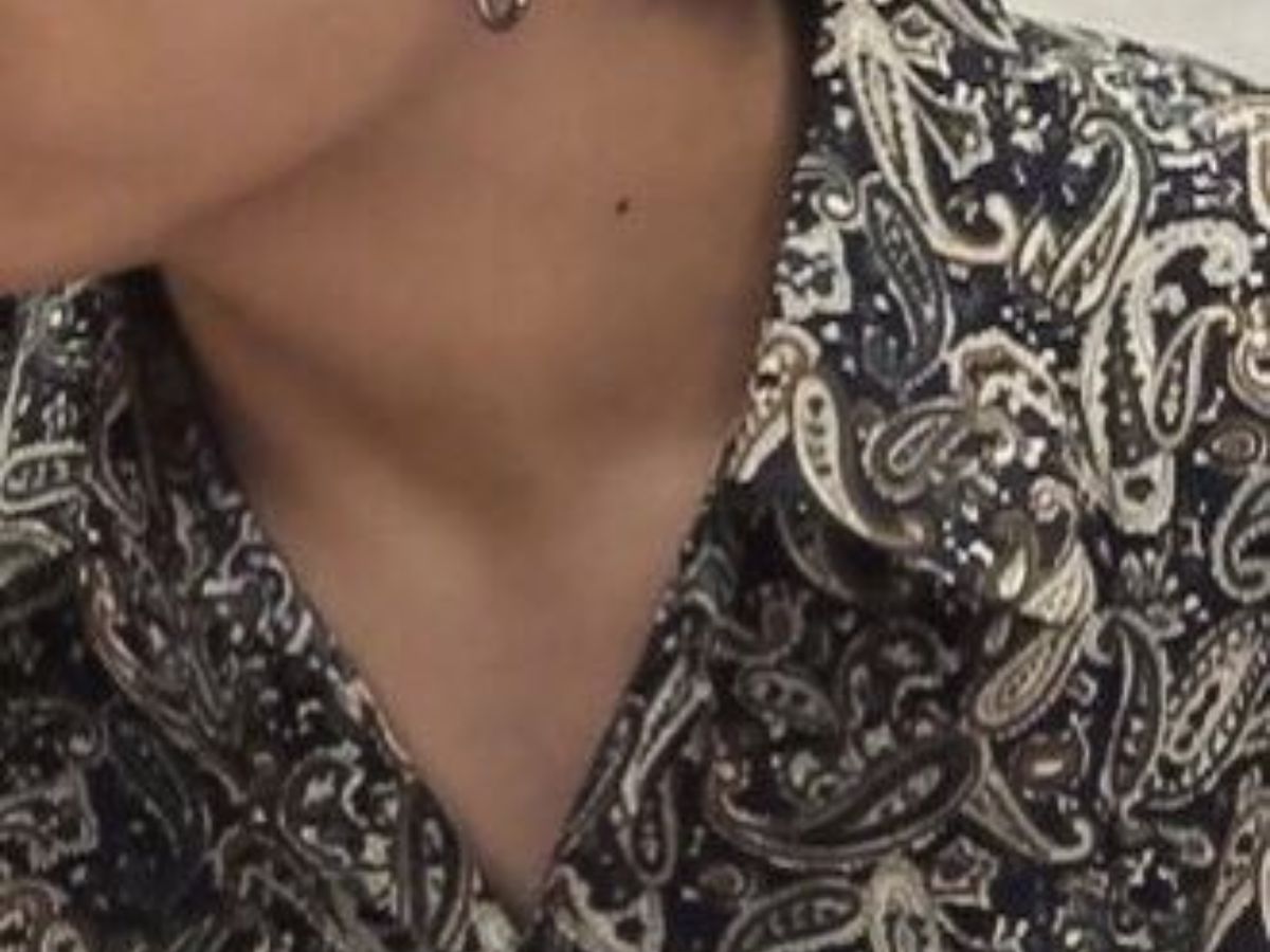 Mole On The Neck