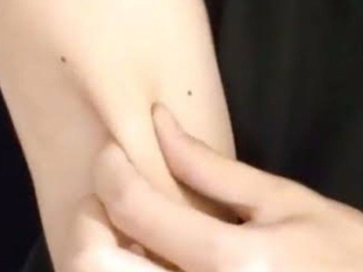Mole On The Arms or Hands