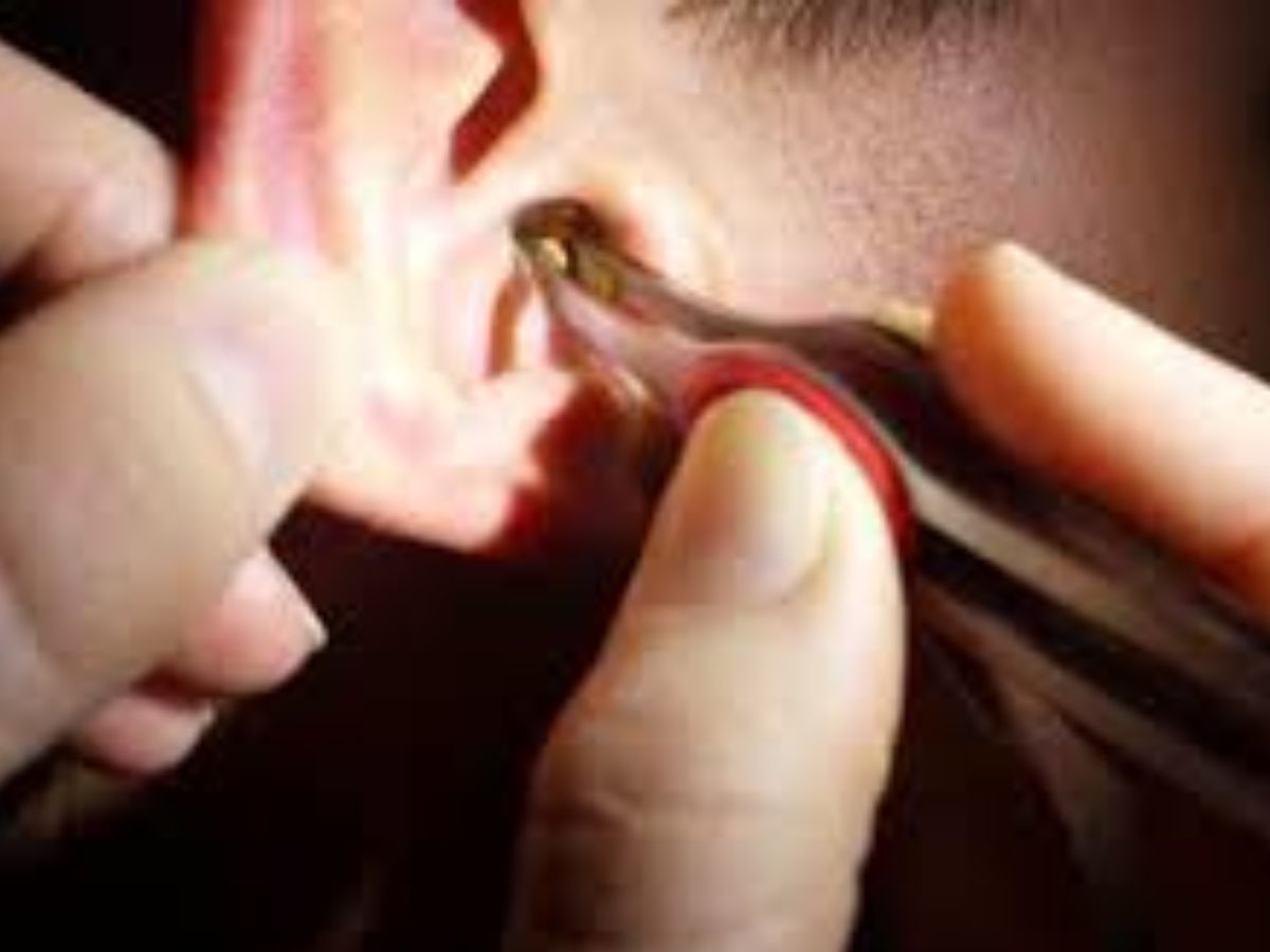 Manual removal by a doctor