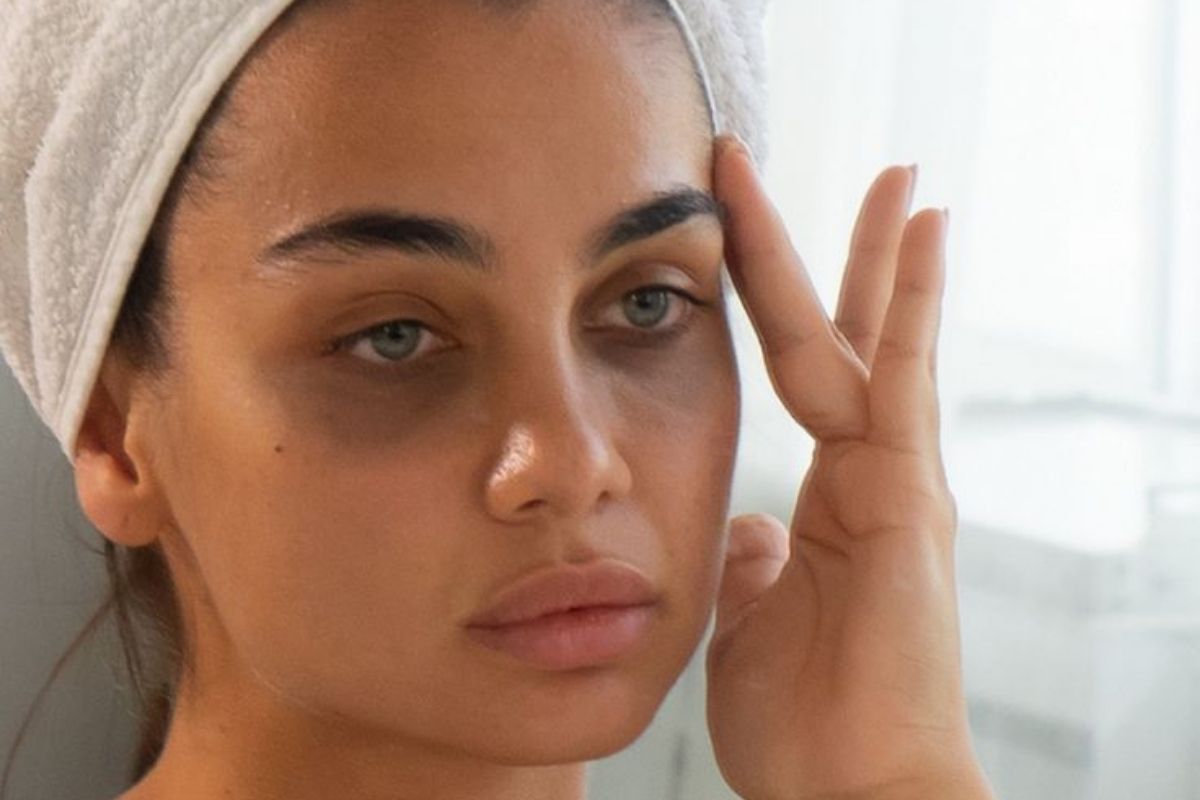 Dark Circles under Eyes