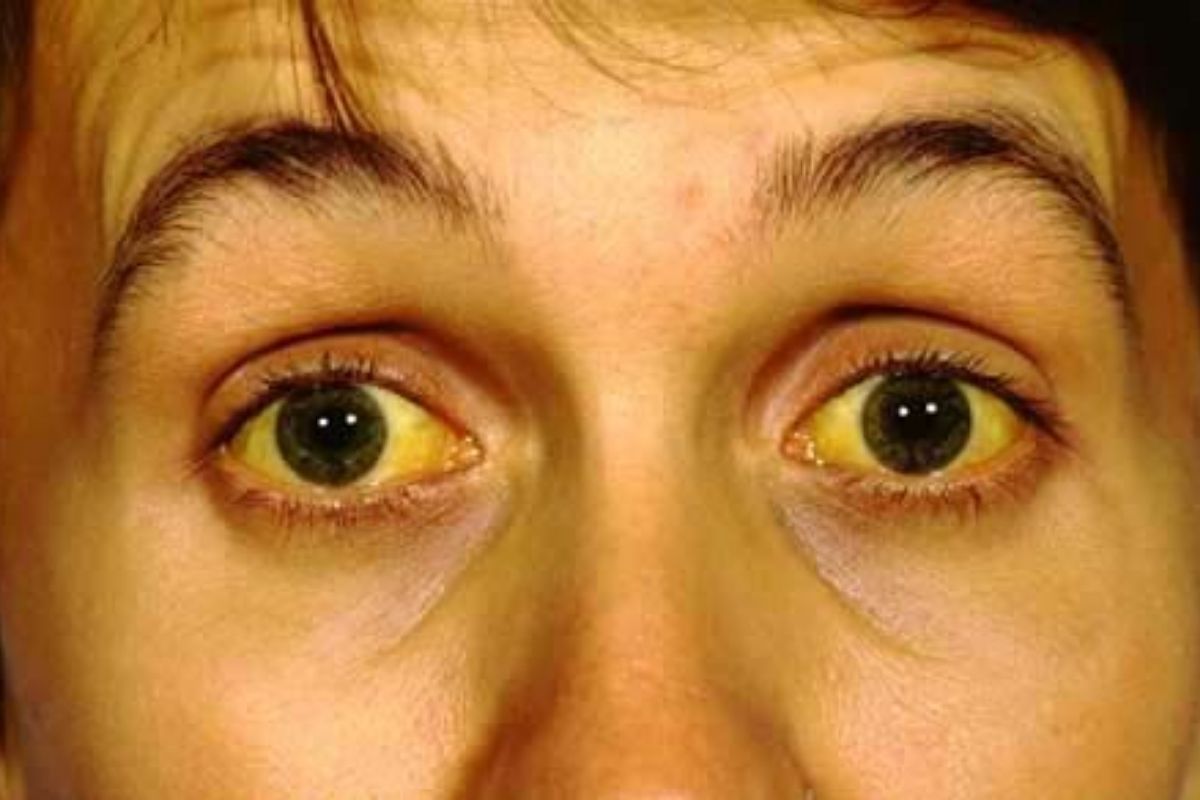 Yellowish Skin or Eyes (Jaundice)