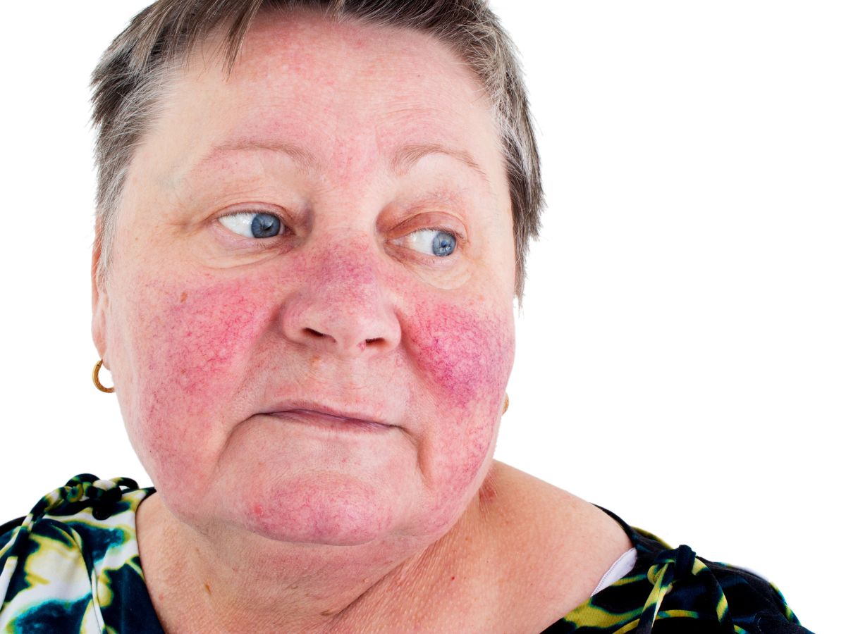 Redness and Irritation