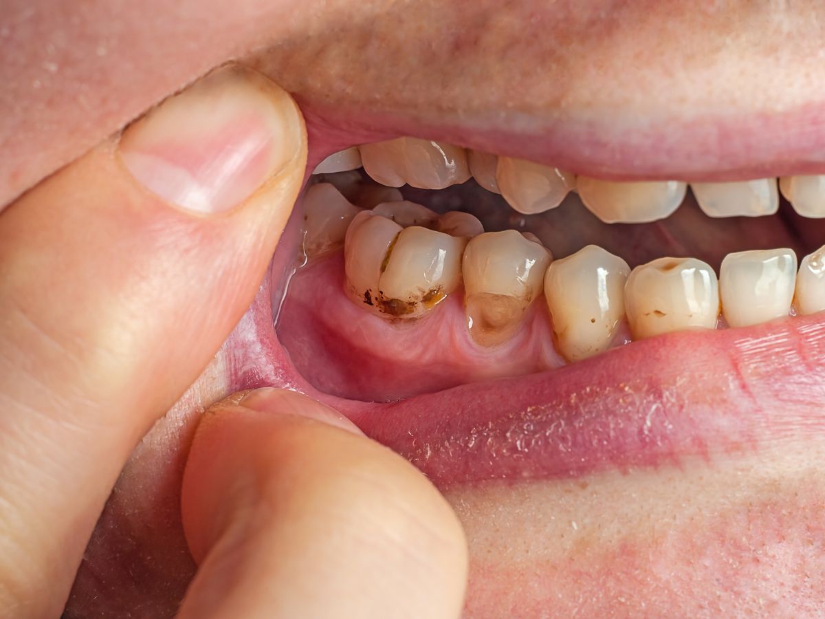 The Hazards of Bad Bacteria