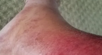 Flesh-Eating Bacteria Kills Four In Florida, Health Officials Confirm