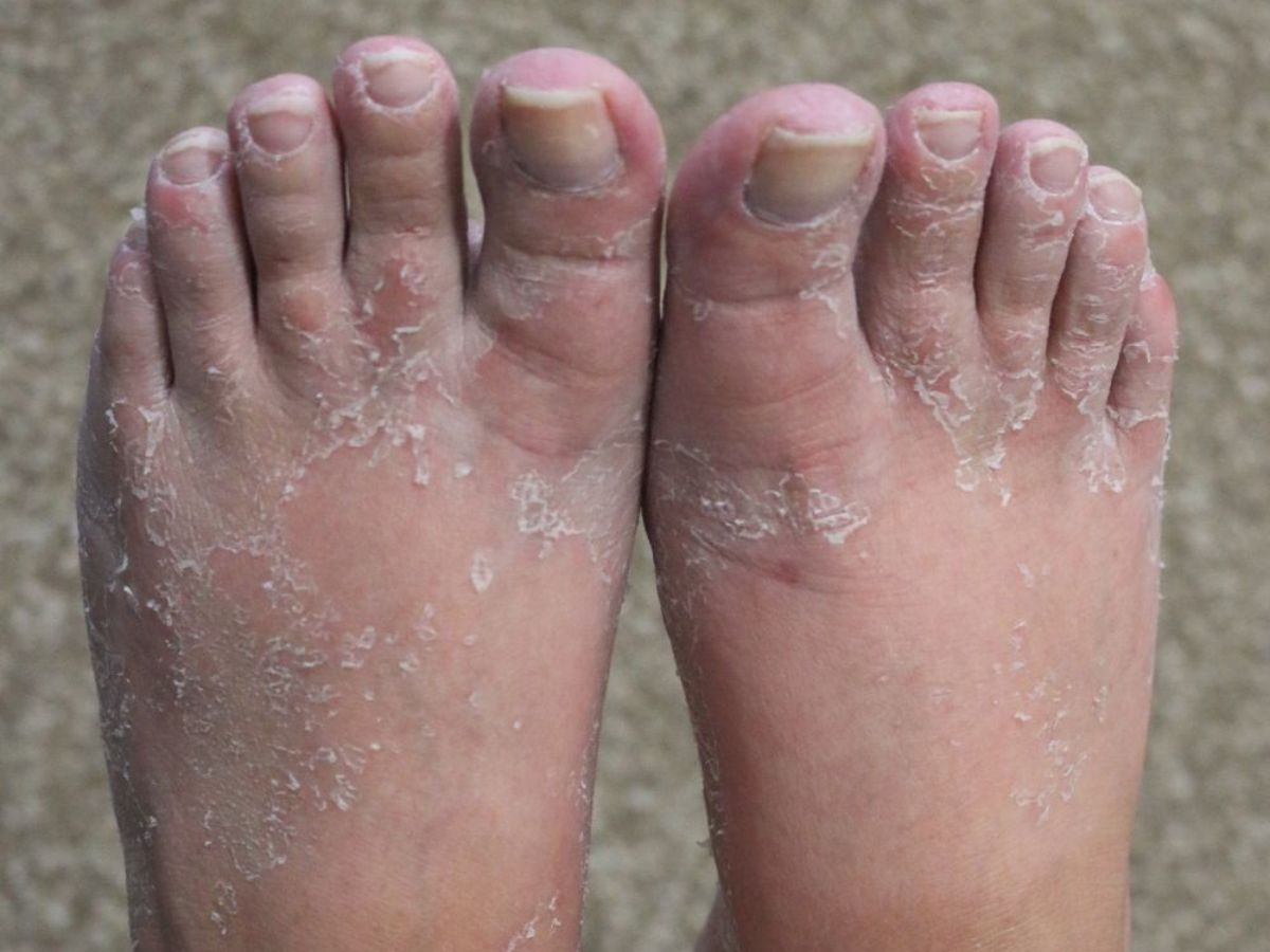 Fungal Infections