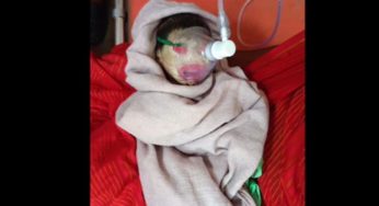 Madhya Pradesh: Pregnant Woman Delivers Baby With Rare Genetic Disorder, Bathed In Open ICU Care