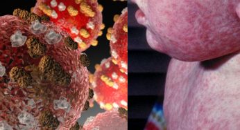 Measles Cases In US Hit Highest Since 1992, First Deaths In A Decade Reported: What Is Drawing This Surge?