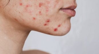 Is Your Acne Caused by a Vitamin Deficiency? Here’s What to Know