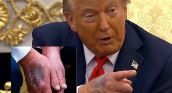 Could Donald Trump Lose A Hand? Doctor Issues Stark Warning