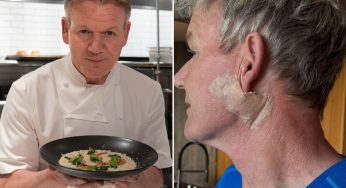 ‘I Promise You It’s Not A Face Lift!’ Gordon Ramsay Shows Off His Surgery Scar After Removing THIS Rare Skin Cancer