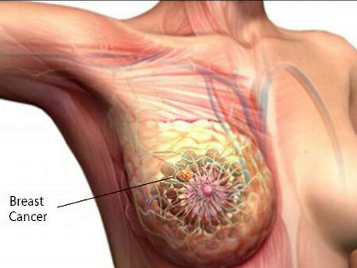 the-truth-about-what-causes-breast-cancer-and-how-we-can-outsmart-it-cancer-breast-cancer-awareness The Truth About What Causes Breast Cancer, And How We Can Outsmart It