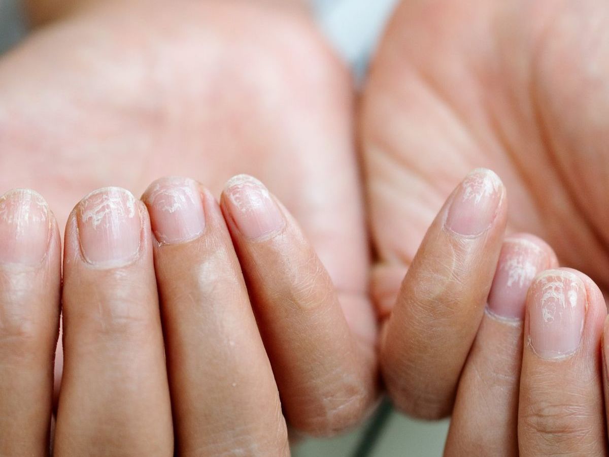 Brittle Nails or Nail Changes