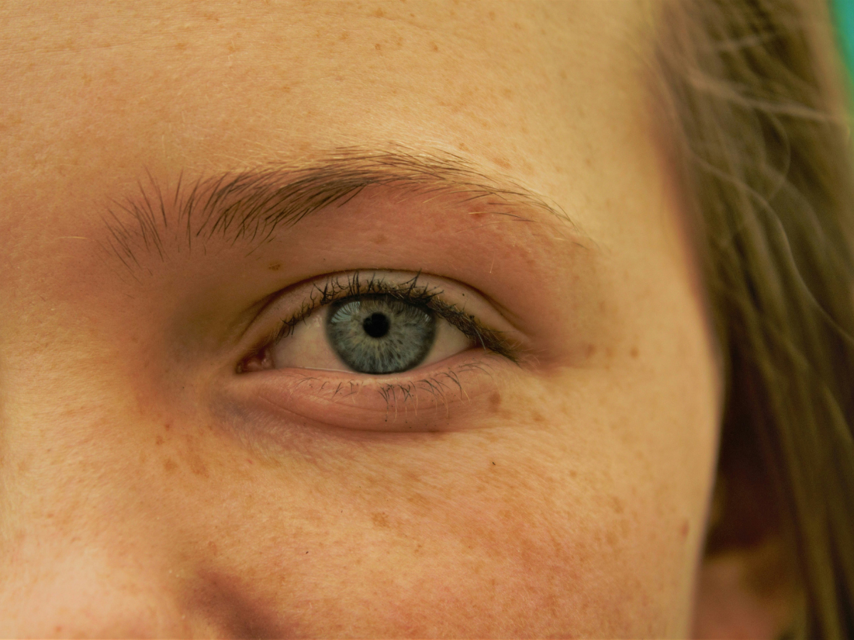 Protects Against Hyperpigmentation