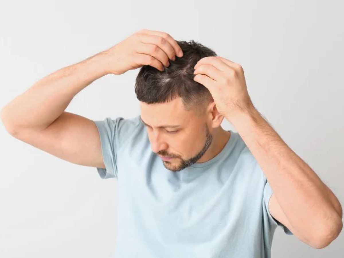 Clascoterone: New Baldness Drug Boosted Hair Growth By 539% In Trials; Know Availability, Pricing