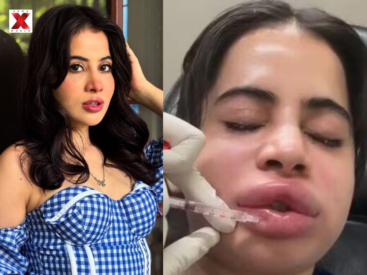 Uorfi Javed Lip Filler Surgery